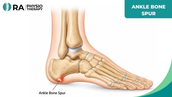 Ankle Bone Spur