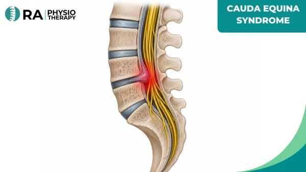 Cauda Equina Syndrome