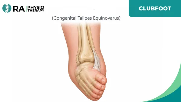 Clubfoot Or Congenital Talipes Equinovarus Or