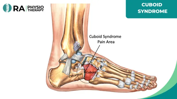 Cuboid Syndrome
