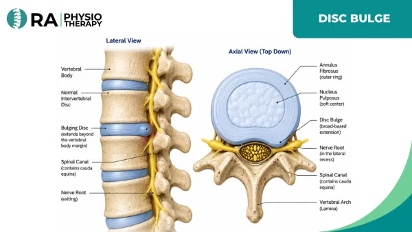 Disc Bulge