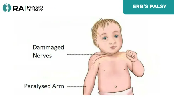 Erb’s Palsy