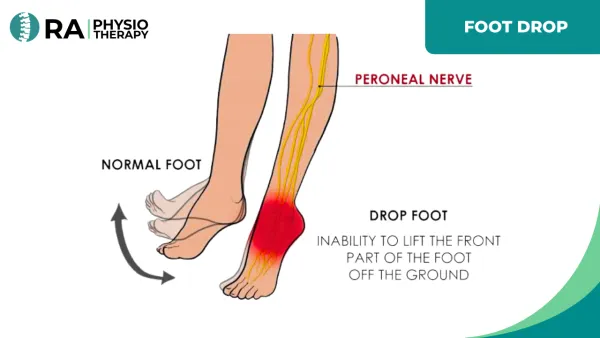 Foot Drop