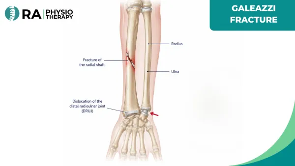 Galeazzi Fracture