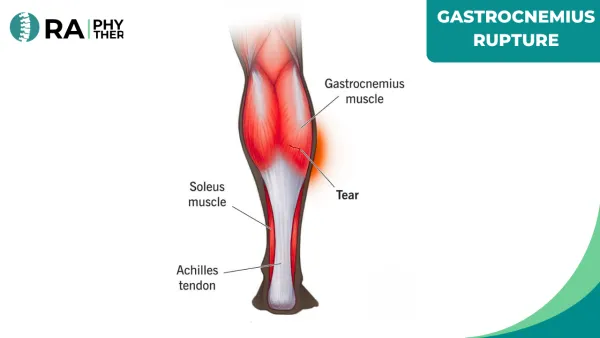 Gastrocnemius Rupture