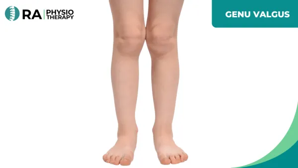 Genu Valgus
