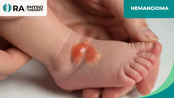 Hemangioma