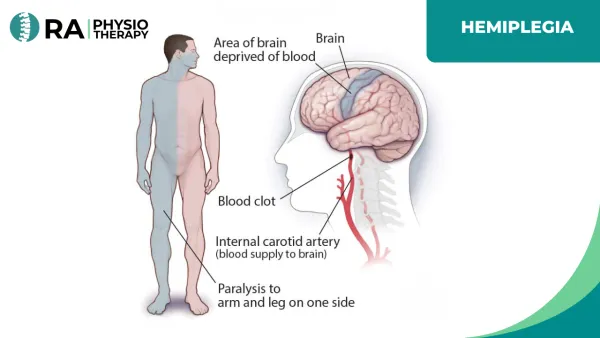 Hemiplegia