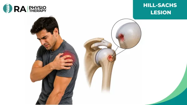 Hill-sachs Lesion