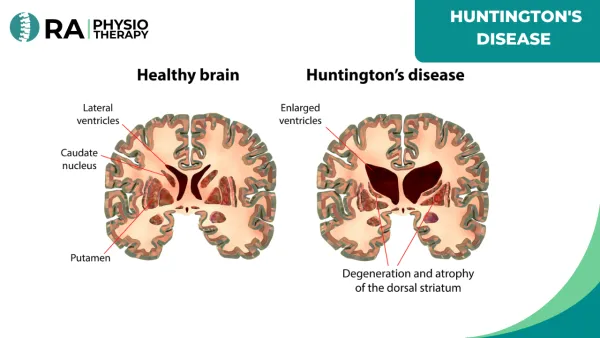 Huntington's Disease (hd)