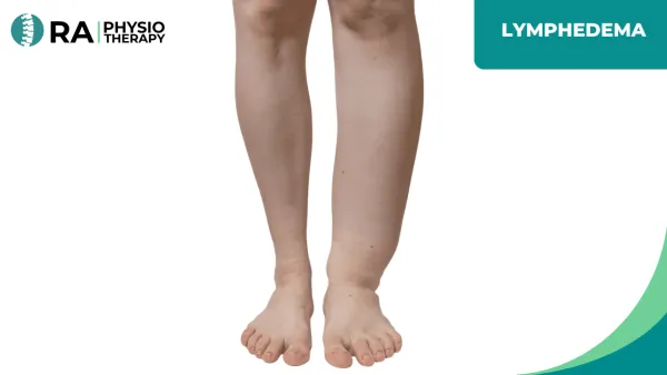 Lymphedema