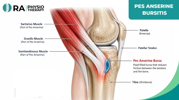 Pes Anserine Bursitis