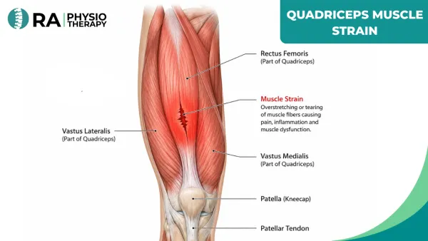 Quadriceps Muscle Strain