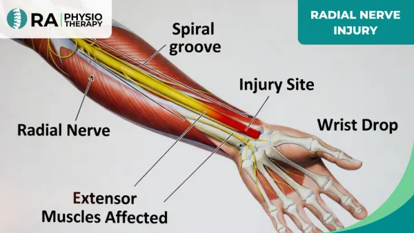 Radial Nerve Injury