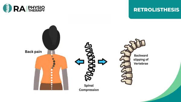 Retrolisthesis
