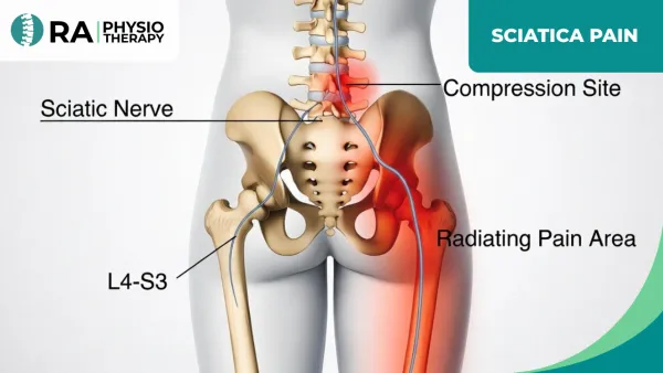 Sciatica