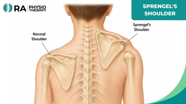 Sprengel's Shoulder