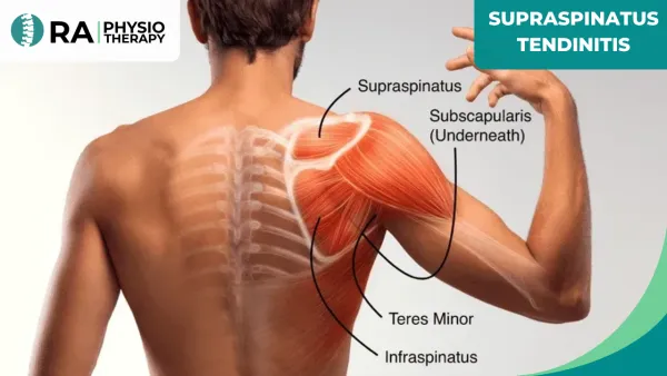 Supraspinatus Tendinitis