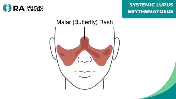 Systemic Lupus Erythematosus (sle)